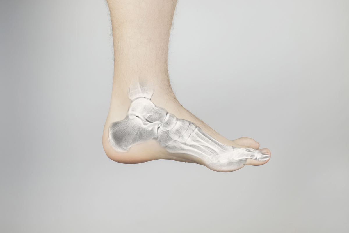 X-Ray of a Foot